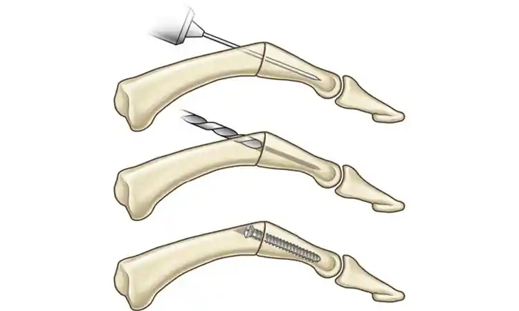 جراحی آرتروز انگشت دست به روش فیوژن