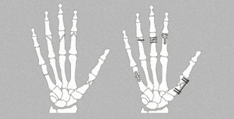 پین گذاری انگشتان دست برای درمان شکستگی