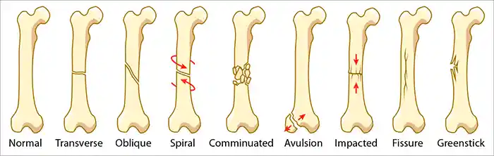 شکستگی استخوان بازو و انواع آن