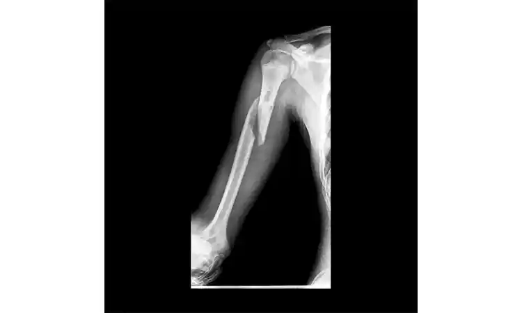 عکس رادیولوژی از شکستگی استخوان بازو