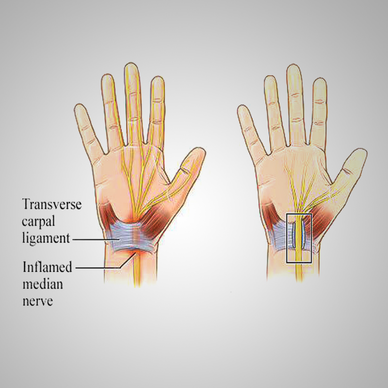 این تصویر چسبندگی در تاندون دست را نشان می دهد. 