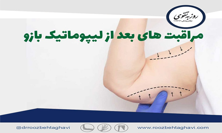 مراقبت های پس از جراحی لاغری بازو (لیپوماتیک)