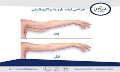 جراحی لاغری بازو (براکیوپلاستی)
