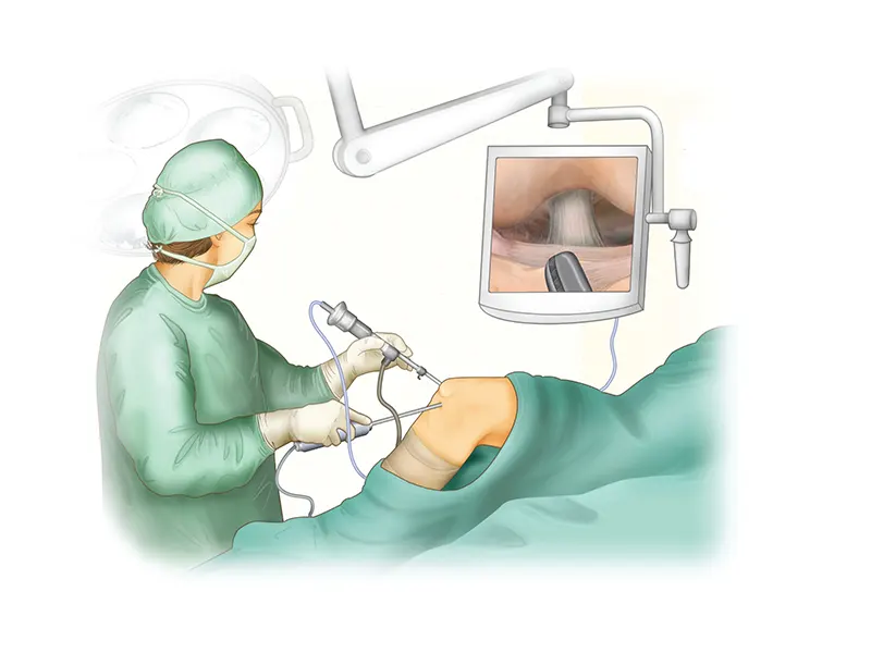 جراحی آرتروسکوپی شانه انواع جراحی شانه