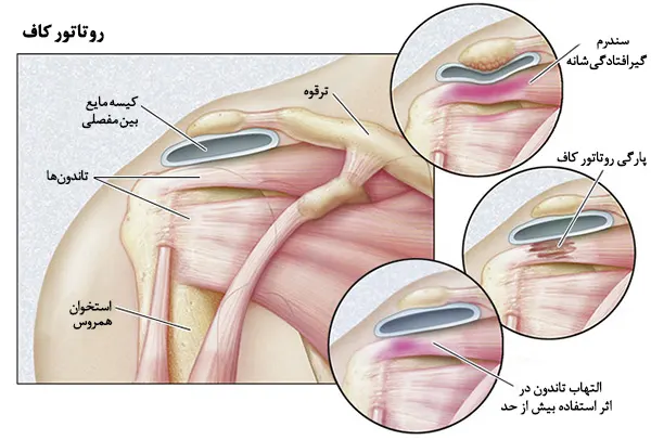 آناتومی مفصل شانه استخوان ها و تاندون ها