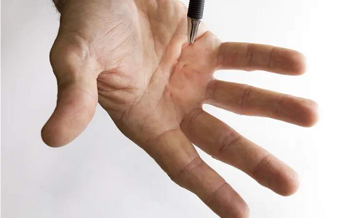 تشخیص پارگی عصب دست