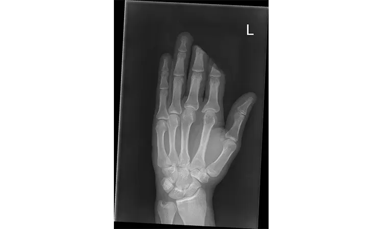 عکس رادیولوژی آمپوتاسیون انگشتان دست