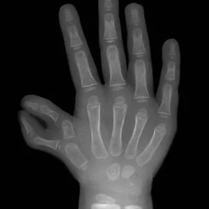 عکس اشعه ایکس پلی داکتیلی