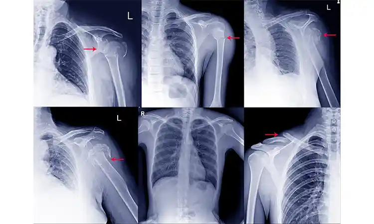 عکس رادیولوژی انواع شکستگی های شانه