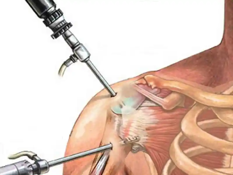 جراحی آرتروسکوپی شانه چیست