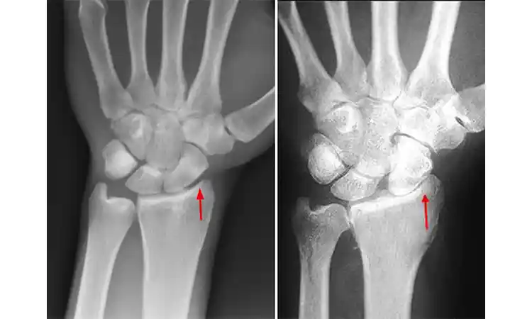 عکس رادیولوژی از آرتروز مچ دست